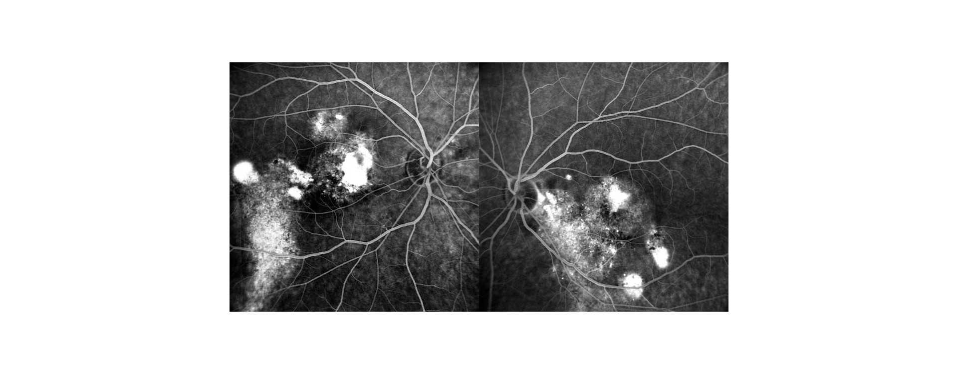 Corioretinopatia Sierosa Centrale Cronica Corioretinopatia Sierosa Centrale Cronica