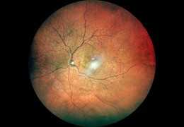 Alberto Bellone: Distacco Retinico Neurosensoriale Dovuto a Trattamento con Sunitinib